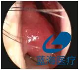 等離子消融術(shù)